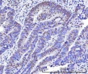 IHC staining of FFPE human rectum adenocarcinoma tissue with OTT3 antibody. HIER: boil tissue sections in pH8 EDTA for 20 min and allow to cool before testing.