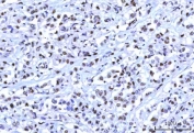 IHC staining of FFPE human breast cancer tissue with OTT3 antibody. HIER: boil tissue sections in pH8 EDTA for 20 min and allow to cool before testing.
