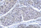 IHC staining of FFPE human liver cancer tissue with OTT3 antibody. HIER: boil tissue sections in pH8 EDTA for 20 min and allow to cool before testing.
