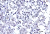 IHC staining of FFPE human undifferentiated carcinoma of the pancreas tissue with OTT3 antibody. HIER: boil tissue sections in pH8 EDTA for 20 min and allow to cool before testing.