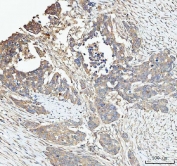 IHC staining of FFPE human ovarian cancer tissue with Sorting nexin 1 antibody. HIER: boil tissue sections in pH8 EDTA for 20 min and allow to cool before testing.