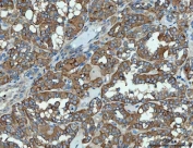 IHC staining of FFPE human thyroid cancer tissue with Sorting nexin 1 antibody. HIER: boil tissue sections in pH8 EDTA for 20 min and allow to cool before testing.