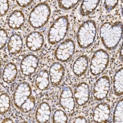 IHC staining of FFPE human colon adenocarcinoma tissue with SNRNP27 antibody. HIER: boil tissue sections in pH8 EDTA for 20 min and allow to cool before testing.