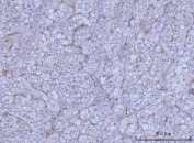 IHC staining of FFPE human adrenocortical adenoma tissue with WRS antibody. HIER: boil tissue sections in pH8 EDTA for 20 min and allow to cool before testing.