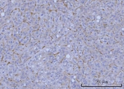 IHC staining of FFPE human liver cancer tissue with WRS antibody. HIER: boil tissue sections in pH8 EDTA for 20 min and allow to cool before testing.