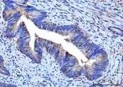 IHC staining of FFPE human rectum adenocarcinoma tissue with Small ribosomal subunit protein uS7 antibody. HIER: boil tissue sections in pH8 EDTA for 20 min and allow to cool before testing.