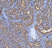 IHC staining of FFPE human thyroid papillary carcinoma tissue with P15RS antibody. HIER: boil tissue sections in pH8 EDTA for 20 min and allow to cool before testing.