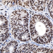 IHC staining of FFPE human endometrioid adenocarcinoma tissue with SNRNP200 antibody. HIER: boil tissue sections in pH8 EDTA for 20 min and allow to cool before testing.