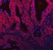Immunofluorescent staining of FFPE human intestinal cancer tissue with SNRNP200 antibody (red) and DAPI nuclear stain (blue). HIER: steam section in pH8 EDTA buffer for 20 min.