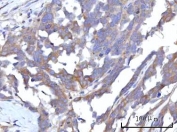 IHC staining of FFPE human ovary serous carcinoma tissue with RAP1GAP antibody. HIER: boil tissue sections in pH8 EDTA for 20 min and allow to cool before testing.
