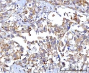 IHC staining of FFPE human gastric adenocarcinoma tissue with RAP1GAP antibody. HIER: boil tissue sections in pH8 EDTA for 20 min and allow to cool before testing.