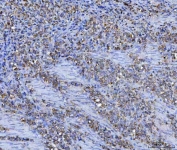 IHC staining of FFPE human gastric carcinoma tissue with ASNS antibody. HIER: boil tissue sections in pH8 EDTA for 20 min and allow to cool before testing.