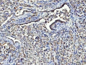 IHC staining of FFPE human lung cancer tissue with ASNS antibody. HIER: boil tissue sections in pH8 EDTA for 20 min and allow to cool before testing.