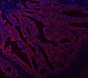 Immunofluorescent staining of FFPE human intestinal cancer tissue with ASNS antibody (red) and DAPI nuclear stain (blue). HIER: steam section in pH8 EDTA buffer for 20 min.