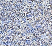 IHC staining of FFPE human testicular germ cell tumor tissue with ASNS antibody. HIER: boil tissue sections in pH8 EDTA for 20 min and allow to cool before testing.