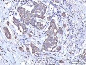 IHC staining of FFPE human esophageal squamous carcinoma tissue with RBFA antibody. HIER: boil tissue sections in pH8 EDTA for 20 min and allow to cool before testing.