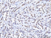 IHC staining of FFPE human breast cancer tissue with RANBP2 antibody. HIER: boil tissue sections in pH8 EDTA for 20 min and allow to cool before testing.