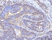 IHC staining of FFPE human rectum adenocarcinoma tissue with RANBP2 antibody. HIER: boil tissue sections in pH8 EDTA for 20 min and allow to cool before testing.