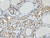 IHC staining of FFPE human thyroid cancer tissue with TTLL12 antibody. HIER: boil tissue sections in pH8 EDTA for 20 min and allow to cool before testing.