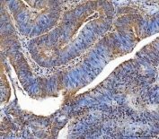 IHC staining of FFPE human colorectal adenocarcinoma tissue with TTLL12 antibody. HIER: boil tissue sections in pH8 EDTA for 20 min and allow to cool before testing.
