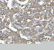 Immunohistochemical staining of FFPE human breast cancer tissue with SGSH antibody, HRP-secondary and DAB substrate. HIER: boil tissue sections in pH8 EDTA for 20 min and allow to cool before testing.