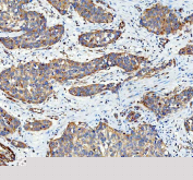 Immunohistochemical staining of FFPE human urothelium carcinoma tissue with SGSH antibody, HRP-secondary and DAB substrate. HIER: boil tissue sections in pH8 EDTA for 20 min and allow to cool before testing.