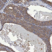 IHC staining of FFPE human breast cancer tissue with SHQ1 antibody. HIER: boil tissue sections in pH8 EDTA for 20 min and allow to cool before testing.