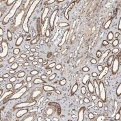IHC staining of FFPE human renal cancer tissue with SHQ1 antibody. HIER: boil tissue sections in pH8 EDTA for 20 min and allow to cool before testing.
