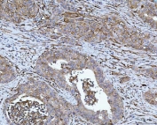 IHC staining of FFPE human rectal cancer tissue with B7-H3 antibody. HIER: boil tissue sections in pH8 EDTA for 20 min and allow to cool before testing.