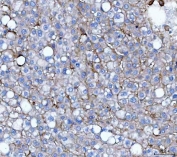 IHC staining of FFPE human liver cancer tissue with B7-H3 antibody. HIER: boil tissue sections in pH8 EDTA for 20 min and allow to cool before testing.