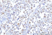 IHC staining of FFPE human lung adenocarcinoma tissue with PTPIP51 antibody. HIER: boil tissue sections in pH8 EDTA for 20 min and allow to cool before testing.