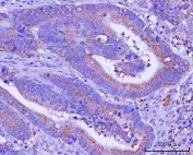 IHC staining of FFPE human rectum adenocarcinoma tissue with PTPIP51 antibody. HIER: boil tissue sections in pH8 EDTA for 20 min and allow to cool before testing.