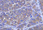 IHC staining of FFPE human liver cancer tissue with PTPIP51 antibody. HIER: boil tissue sections in pH8 EDTA for 20 min and allow to cool before testing.