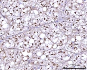 IHC staining of FFPE human adrenocortical adenoma tissue with RFX1 antibody. HIER: boil tissue sections in pH8 EDTA for 20 min and allow to cool before testing.