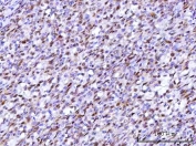 IHC staining of FFPE human intestine diffuse large B-cell lymphoma tissue with RFX1 antibody. HIER: boil tissue sections in pH8 EDTA for 20 min and allow to cool before testing.