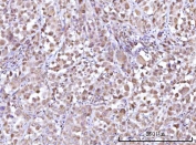 IHC staining of FFPE human lung adenocarcinoma tissue with RFX1 antibody. HIER: boil tissue sections in pH8 EDTA for 20 min and allow to cool before testing.