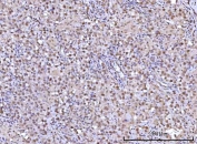 IHC staining of FFPE human testicular seminoma tissue with RFX1 antibody. HIER: boil tissue sections in pH8 EDTA for 20 min and allow to cool before testing.