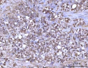 IHC staining of FFPE human gastric adenocarcinoma tissue with RFX1 antibody. HIER: boil tissue sections in pH8 EDTA for 20 min and allow to cool before testing.
