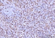 IHC staining of FFPE human testicular seminoma tissue with RNF40 antibody. HIER: boil tissue sections in pH8 EDTA for 20 min and allow to cool before testing.