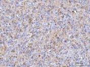 IHC staining of FFPE human glioma tissue with HBBM antibody. HIER: boil tissue sections in pH8 EDTA for 20 min and allow to cool before testing.