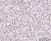 IHC staining of FFPE human testicular seminoma tissue with mRNA-capping enzyme antibody. HIER: boil tissue sections in pH8 EDTA for 20 min and allow to cool before testing.