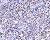 IHC staining of FFPE human intestine diffuse large B-cell lymphoma tissue with mRNA-capping enzyme antibody. HIER: boil tissue sections in pH8 EDTA for 20 min and allow to cool before testing.