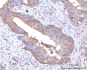 IHC staining of FFPE human rectum adenocarcinoma tissue with mRNA-capping enzyme antibody. HIER: boil tissue sections in pH8 EDTA for 20 min and allow to cool before testing.