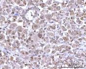IHC staining of FFPE human lung adenocarcinoma tissue with mRNA-capping enzyme antibody. HIER: boil tissue sections in pH8 EDTA for 20 min and allow to cool before testing.