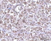 IHC staining of FFPE human lung adenocarcinoma tissue with mRNA-capping enzyme antibody. HIER: boil tissue sections in pH8 EDTA for 20 min and allow to cool before testing.