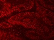Immunofluorescent staining of FFPE human colon cancer tissue with mRNA-capping enzyme antibody (red). HIER: steam section in pH8 EDTA buffer for 20 min.