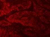 Immunofluorescent staining of FFPE human colon cancer tissue with mRNA-capping enzyme antibody (red). HIER: steam section in pH8 EDTA buffer for 20 min.
