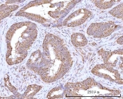 IHC staining of FFPE human rectum adenocarcinoma tissue with RPN1 antibody. HIER: boil tissue sections in pH8 EDTA for 20 min and allow to cool before testing.