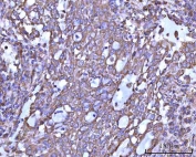 IHC staining of FFPE human lung adenocarcinoma tissue with RPS14 antibody. HIER: boil tissue sections in pH8 EDTA for 20 min and allow to cool before testing.