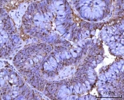 IHC staining of FFPE human colon adenocarcinoma tissue with NNP1 antibody. HIER: boil tissue sections in pH8 EDTA for 20 min and allow to cool before testing.
